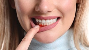 Hammaskiven poisto ja iensairauksien hoito | Hammaslääkäri Arttu Lohi - Tampere